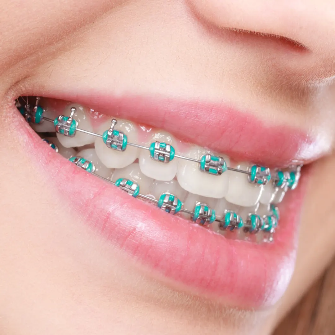 Braces