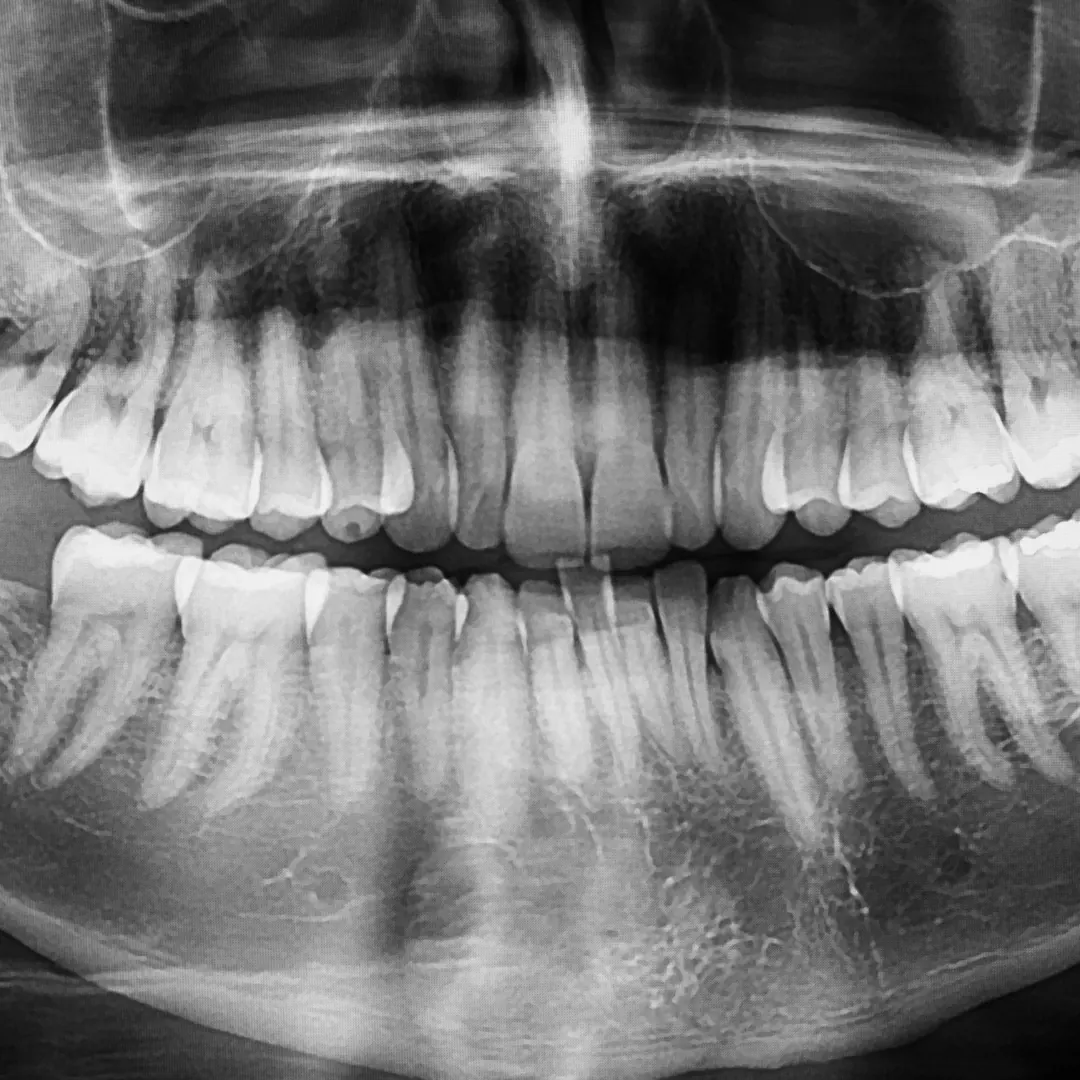 X-Ray