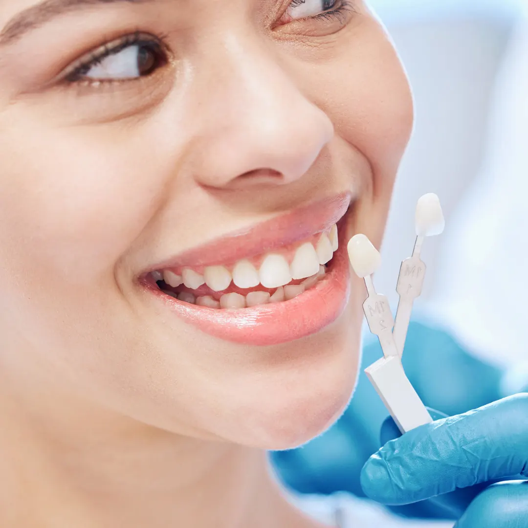 Veneers