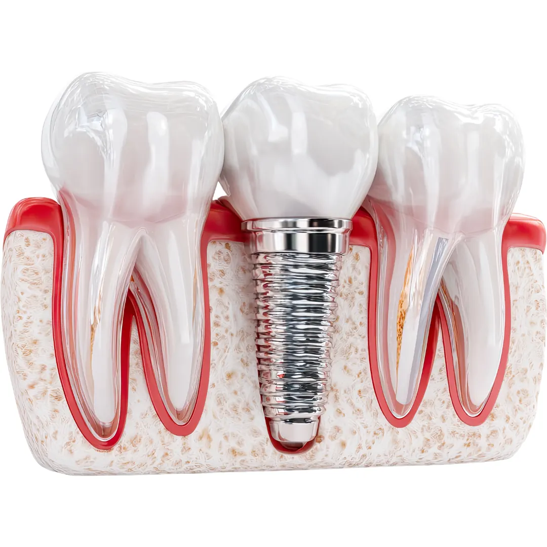 Implant