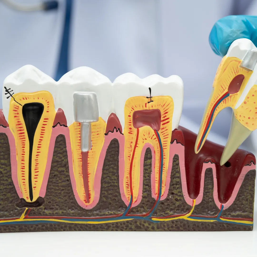 Root Canal