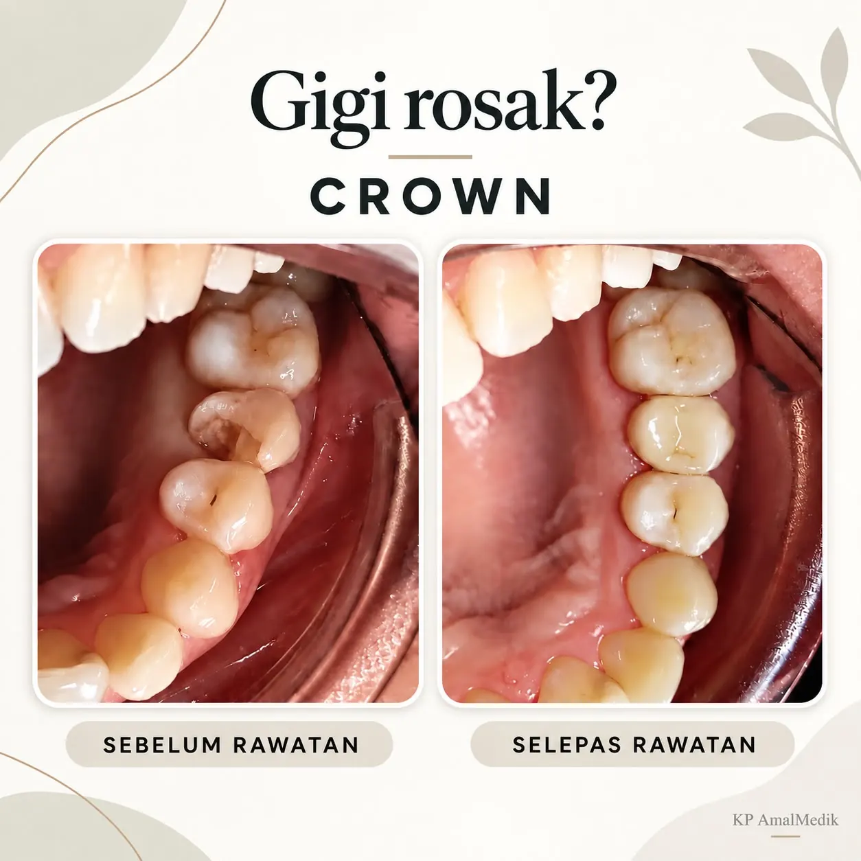Hasil rawatan crown belakang sebelum dan selepas