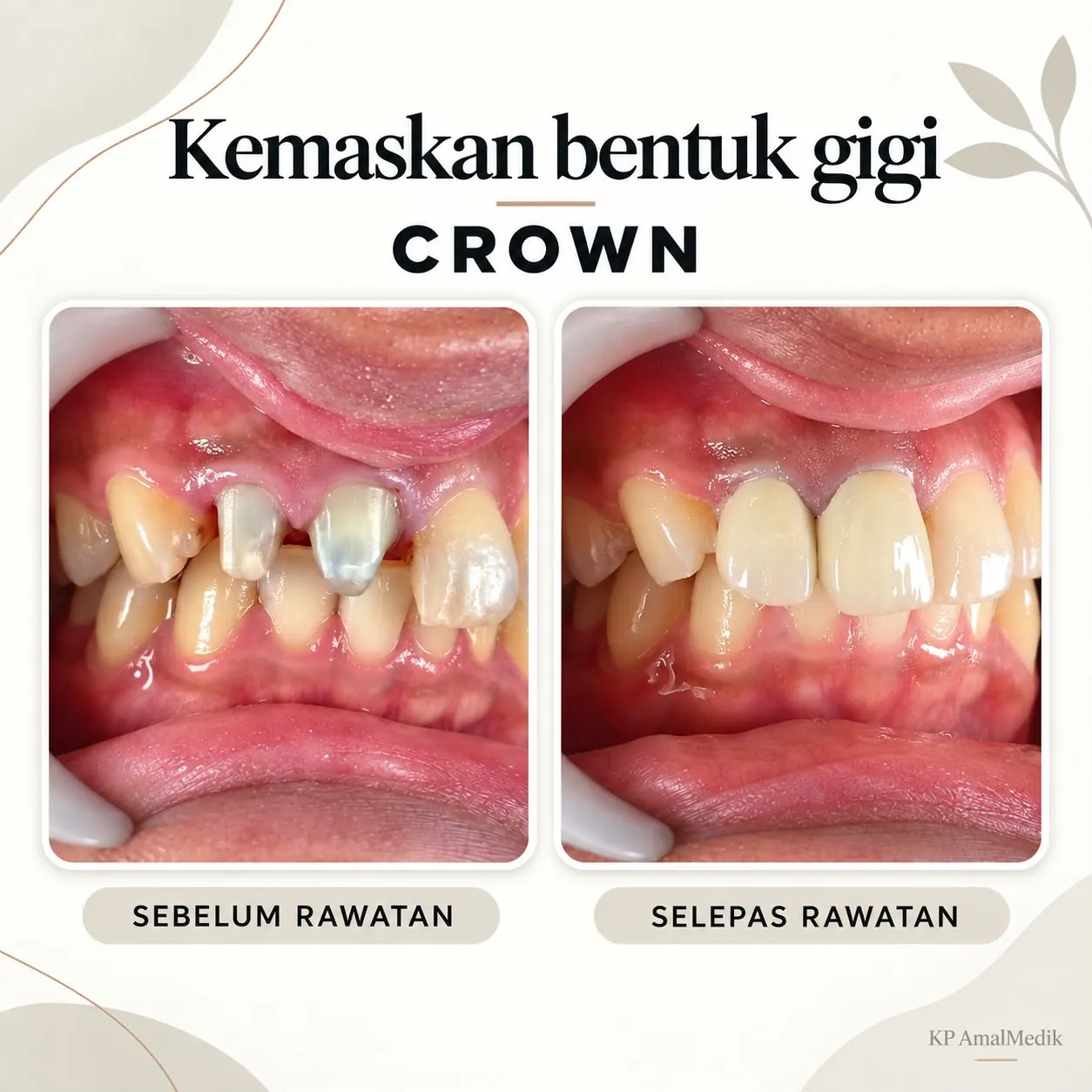 Hasil rawatan crown sebelum dan selepas