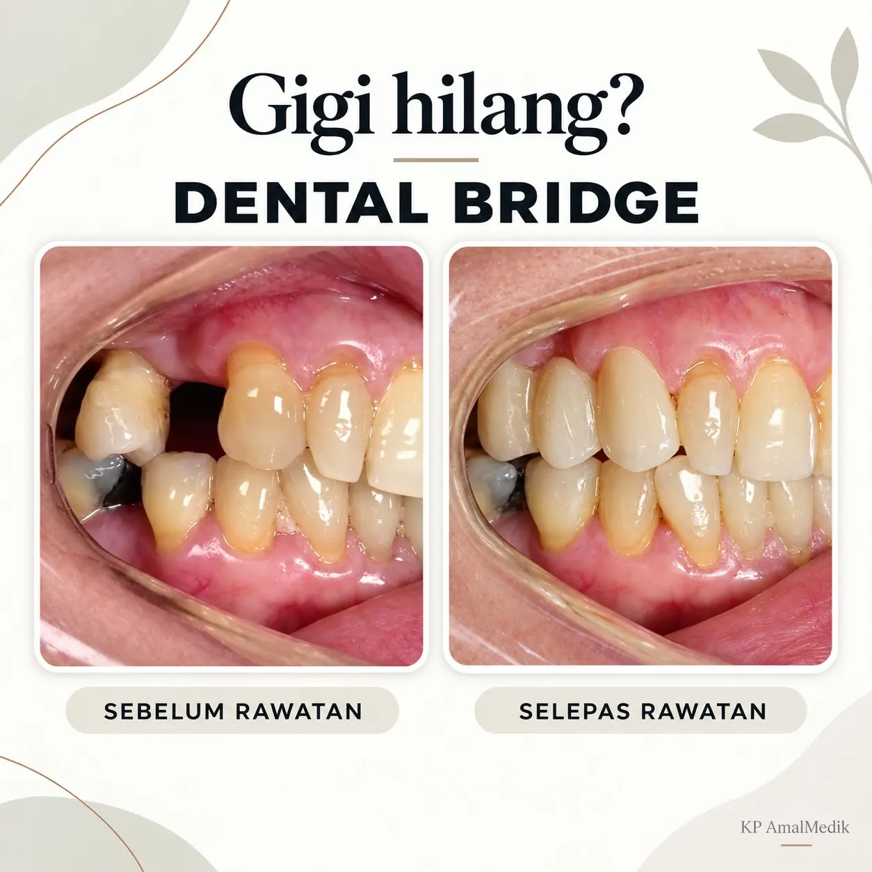 Hasil rawatan dental bridge sebelum dan selepas