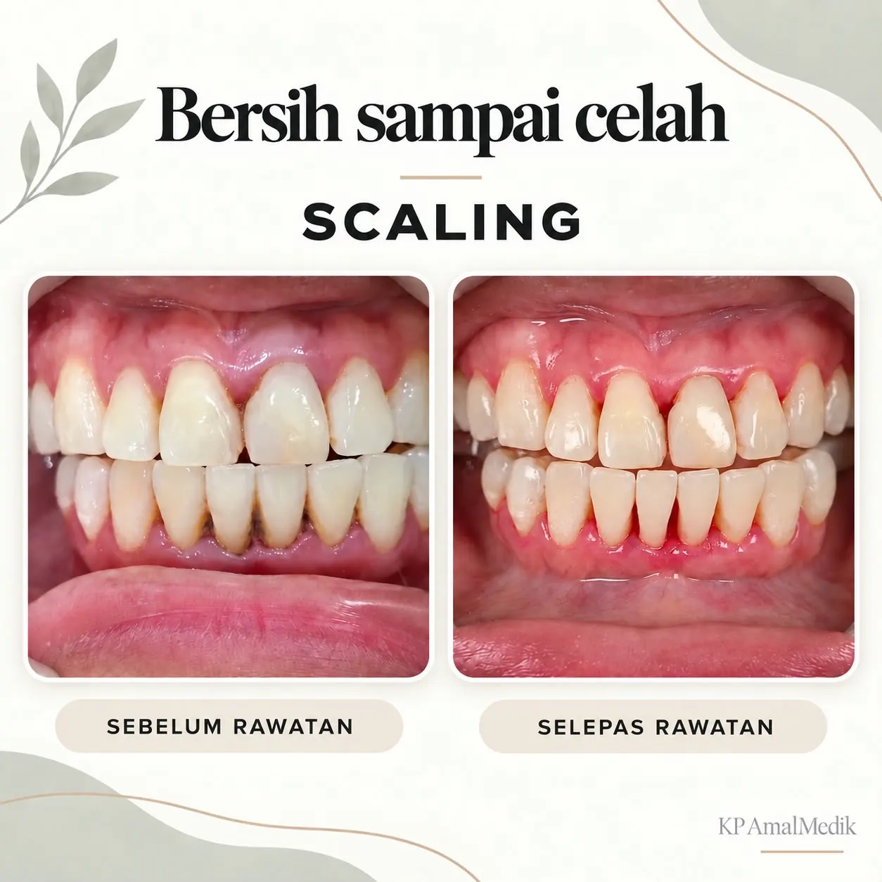 Hasil rawatan scaling sebelum dan selepas