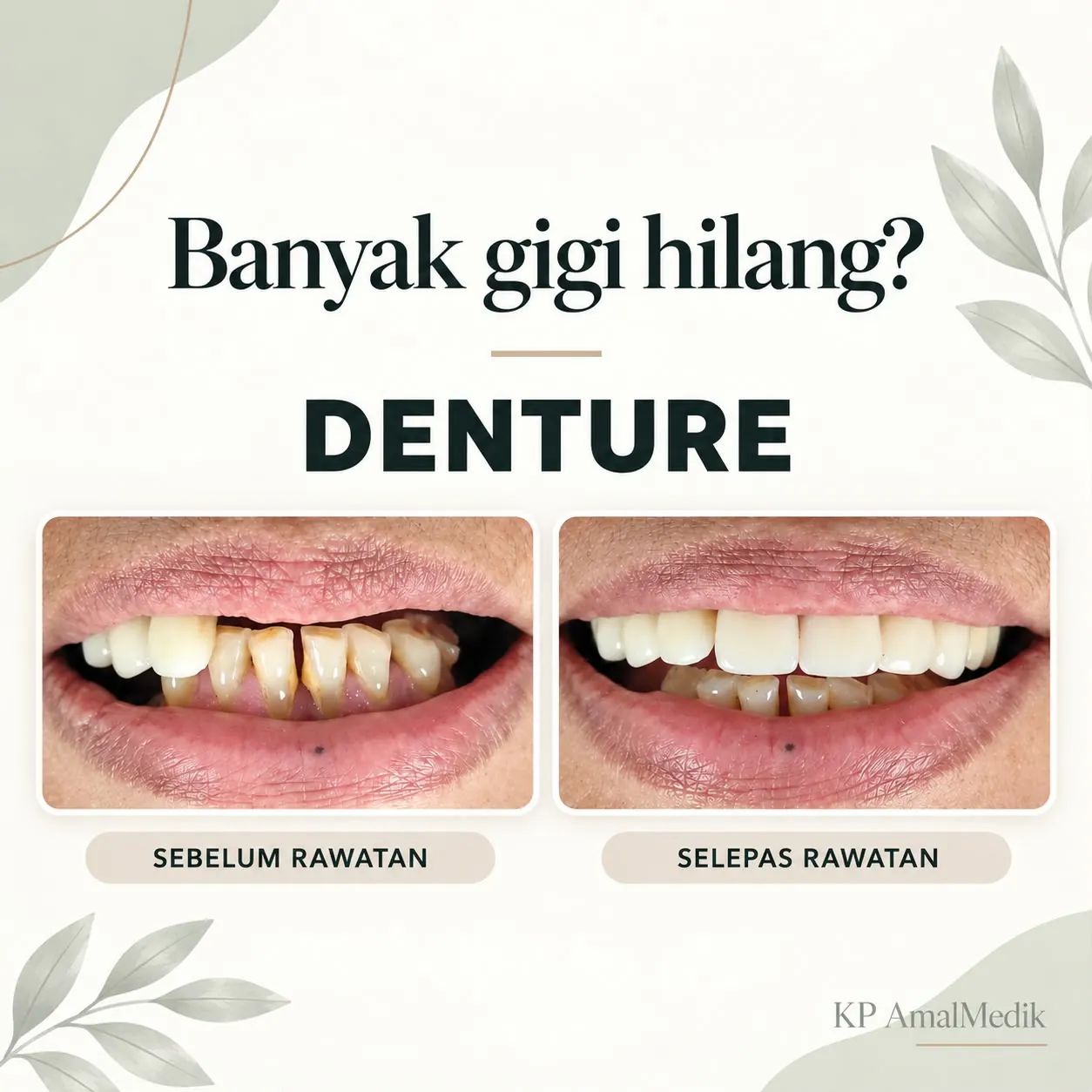 Hasil rawatan denture sebelum dan selepas kes kedua