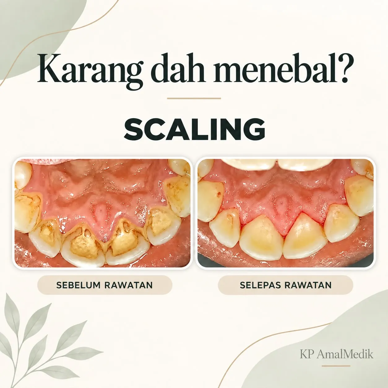Hasil rawatan scaling sebelum dan selepas kes kedua