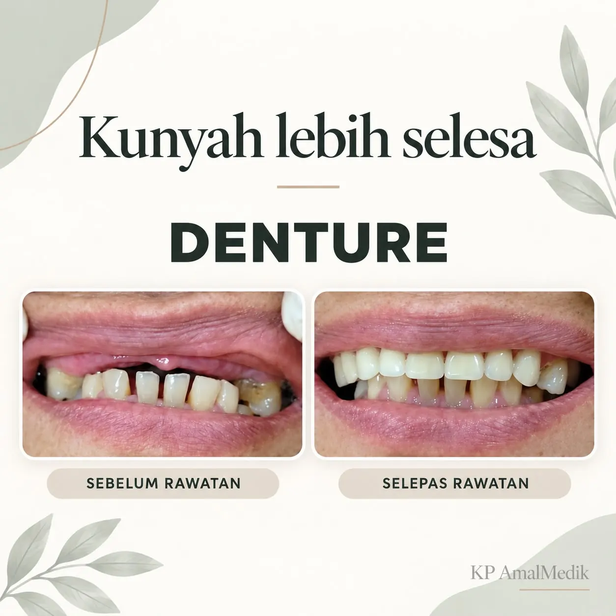 Hasil rawatan denture sebelum dan selepas