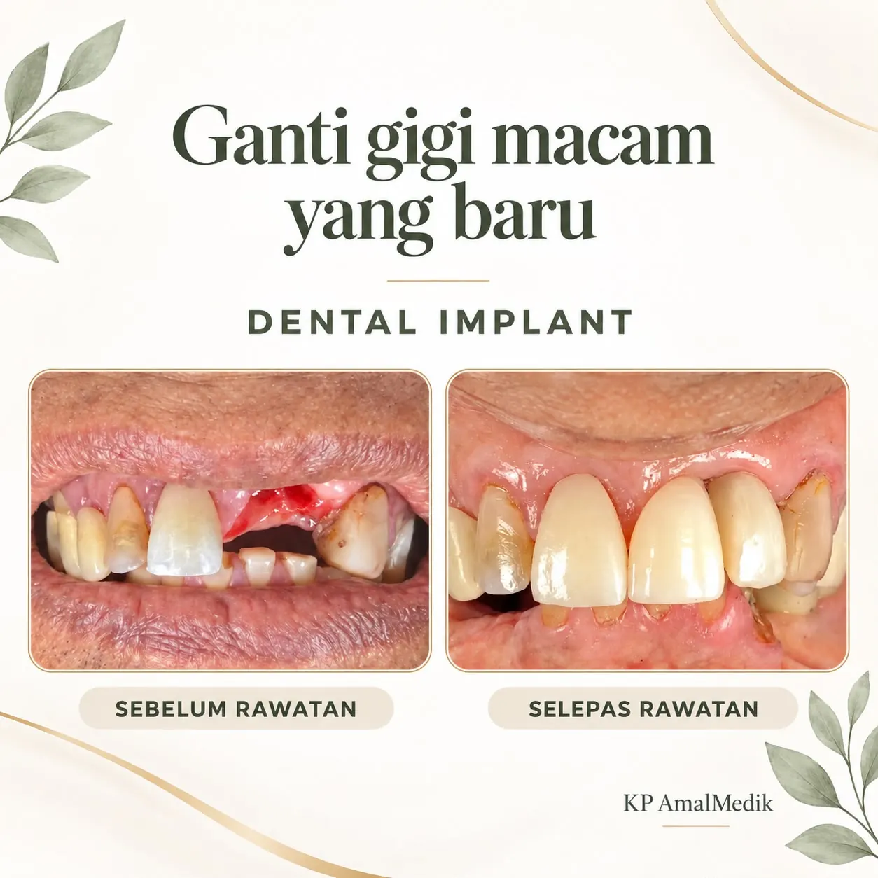 Hasil rawatan dental implant sebelum dan selepas